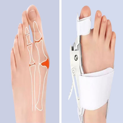 Ayarlanabilir Ayak Baş Parmak Kemik Düzeltici – Halluks Valgus (Bunyon) Aparatı, Gece Gündüz Kullanıma Uygun Ayak Düzeltme Ateli (5643)